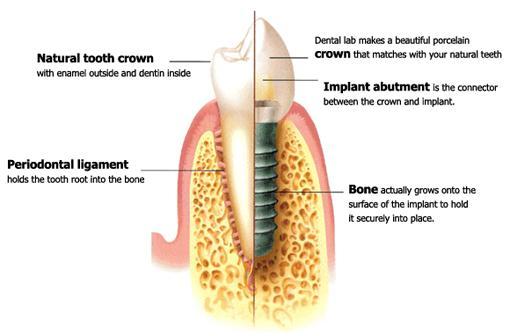 An illustration of a dental implant in Glenmont, NY